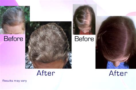 Non Surgical Hair Loss Options Miami Miami Fl