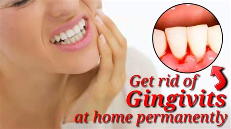 How To Get Rid Of Gingivitis Quickly By Natural Remedies Tips Youtube