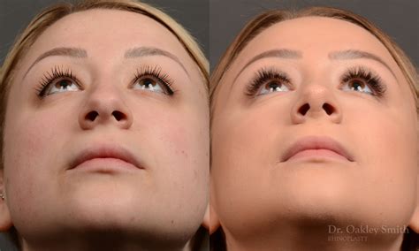 454f Rhinoplasty Dr Oakley Smith Toronto Top Surgeon Nose Job