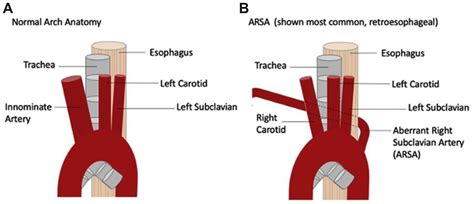 Surgical Repair Of Severe Dysphagia Lusoria Journal Of Vascular