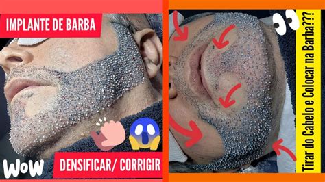 Transplante De Barba Fios Brancos Padraocmc Youtube