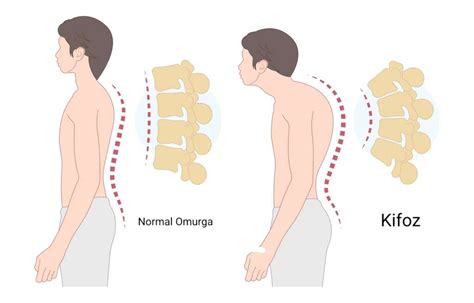 Kifoz Ve Skolyoz Nedir Dr Mehmet Portakal