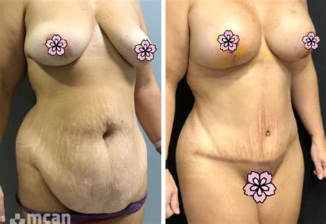 Tummy Tuck Turkey Abdominoplasty Cost Of 2023 MCAN