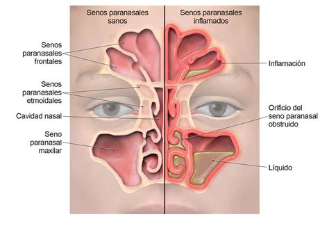 Información básica sobre la sinusitis infección de los senos