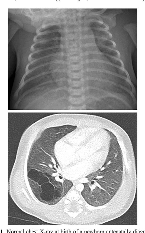 Type I Pleuropulmonary Blastoma Semantic Scholar