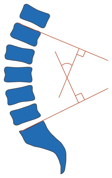 Schematic Diagram Of The Measurement Of Lumbar Lordosis Cobb Angle