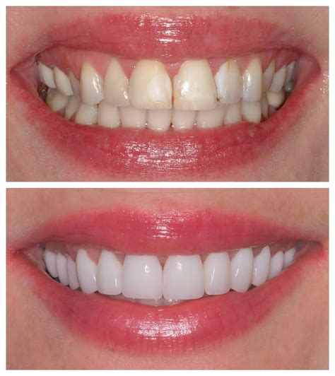 Veneers Process