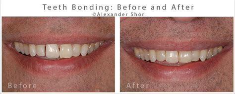 Teeth Bonding Before And After Seattle Shor Dental