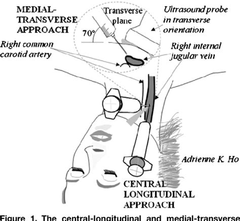 External Jugular Vein Cannulation