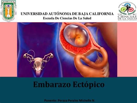 Embarazo Ectopico