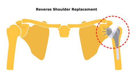 Reverse Shoulder Replacement Faqs Dr Mcclintock Roseville Ca