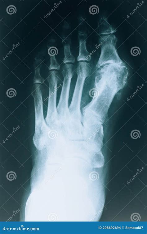 X-ray of the Foot. Human Foot Bones Close Up Stock Photo - Image of ...