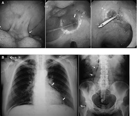 Rectal Perforation After Colonoscopic Polypectomy Presented As Subcutaneous Emphysema