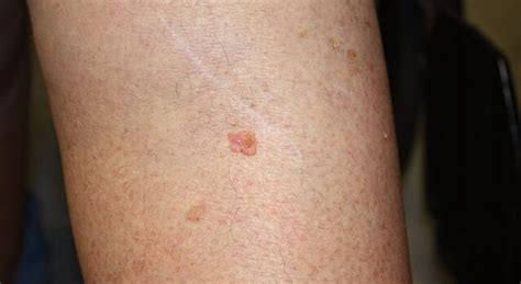 learn  squamous cell skin cancer laser lipo vein center