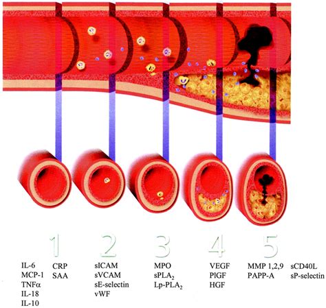 Inflammatory Biomarkers In Acute Coronary Syndromes Circulation