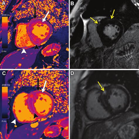 A C Short Axis Native T1 Maps And Bd Corresponding Late Gadolinium