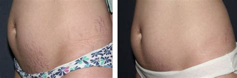 Stretch Mark Removal Denver Centennial Laser Aesthetics Of Colorado