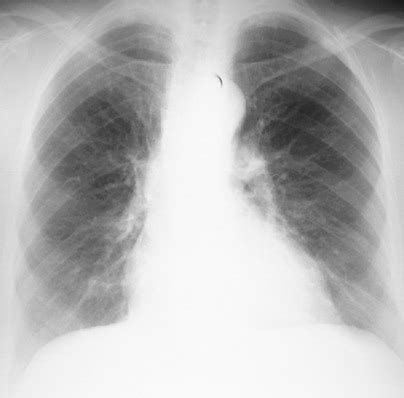 Normal Chest Radiograph Flashcards Quizlet