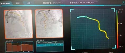 省中医院心血管病科使用caffr技术为冠心病介入诊疗精准导航冠脉