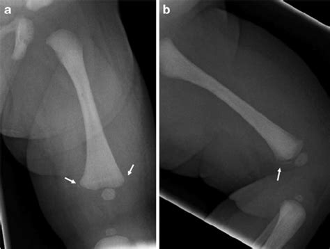 Distal Radial Metaphyseal Fracture