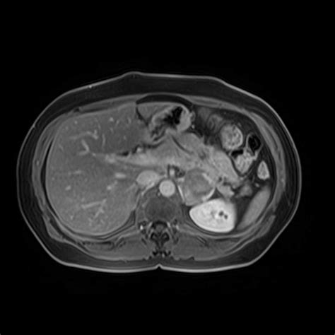 Pheochromocytoma - Body MR Case Studies - CTisus CT Scanning