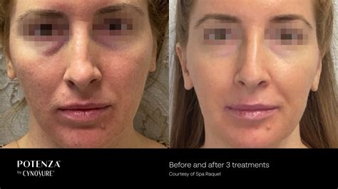 Rf Microneedling Potenza Before And After