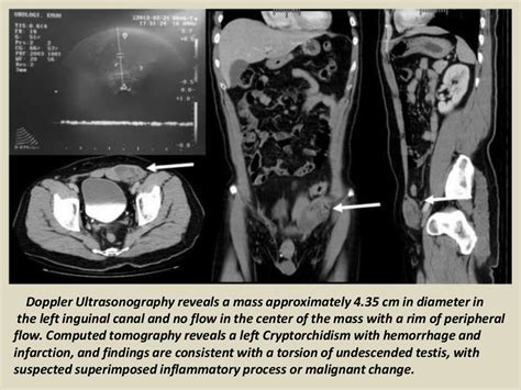 Presentation1 Radiological Imaging Of Undescended Testis