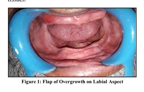 Figure 1 From MANAGEMENT OF EPULIS FISSURATUM OF MANDIBULAR ANTERIOR