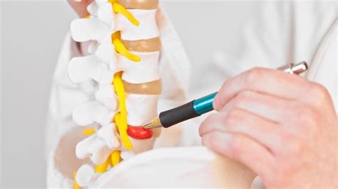 Degenerative Disc Disease Things To Know Precision Spine Care