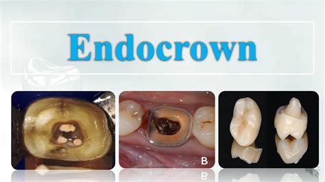 Endocrown | What is & How to make ? - YouTube