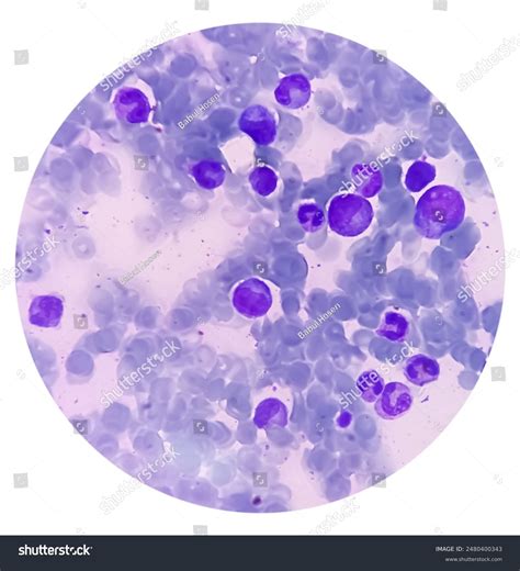 Bms Bone Marrow Study Reactive Marrow Stock Photo 2480400343 | Shutterstock
