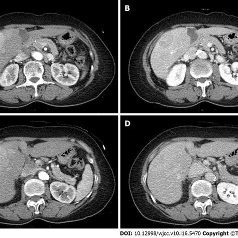 Computed Tomography Of The Patient At The Time Of Hepatocellular