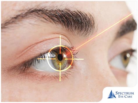 After A Laser Eye Surgery What Are The Things To Expect Spectrum