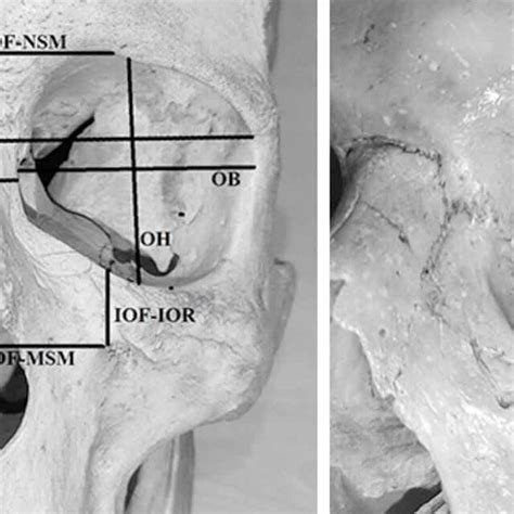 Sof Supraorbital Notchforamen Iof Infraorbital Foramen Pa