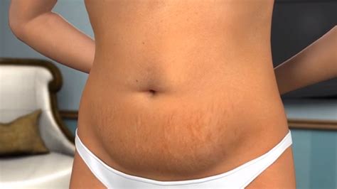 Tummy Tuck Procedure And How It Is Done Thunda Funda