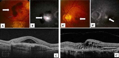 Successful Long Term Management Of Choroidal Neovascularization Secondary To Angioid Streaks In