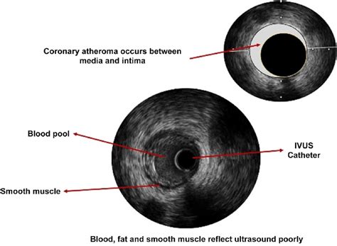 Coronary atheroma by IVUS. | Download Scientific Diagram