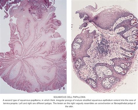 Esophageal Squamous Papilloma Treatment Hpv High Risk Subtypes ...