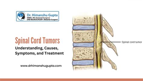 Spinal Cord Tumors Understanding Causes Symptoms And Treatment