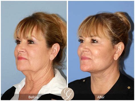 Face And Neck Lift Before After Photos Orange County