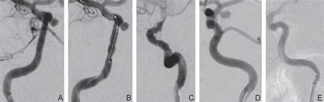 Figure 1 From Risk Factors And Prevention Of Guiding Catheter Induced