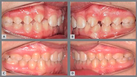 Scielo Brasil Agenesis Of Maxillary Lateral Incisors Diagnosis And