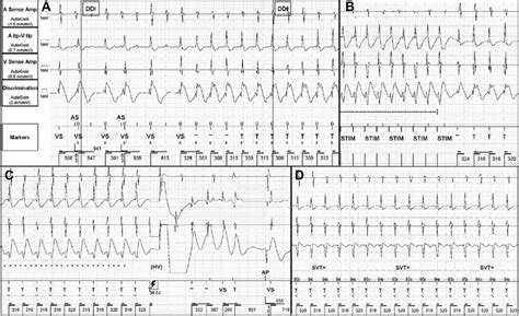 A Intracardiac Electrogram Egm Demonstrating Initial Tachycardia