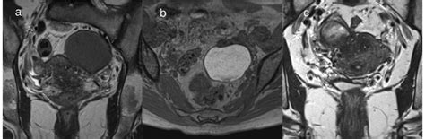 Endometriotic cyst. a, b Endometriotic cyst of the left ovary in a ...