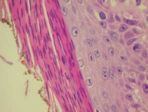 View 11 Bowenoid Actinic Keratosis Histology - wishquotearea