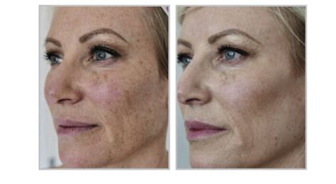 Halo Hybrid Fractional Skin Resurfacing Laser Blue Harbor Dermatology