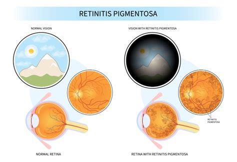 Retinitis Pigmentosa Inheritance Low Vision Blog