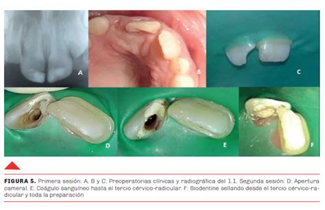 Vista de Aplicación de Biodentine en Endodoncia Regenerativa Revista