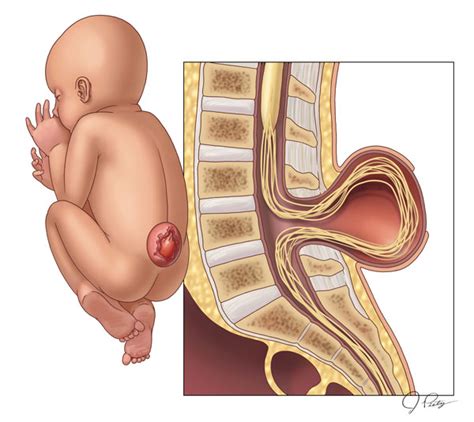 Spina Bifida Obstetrics And Gynecology Maternal Fetal Surgery