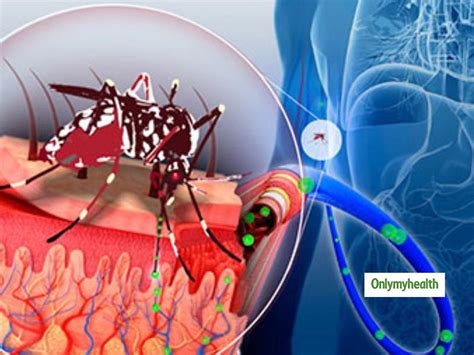 Dengue Symptoms Pictures Dengue Fever In Adults Symptoms Treatments And Prevention Strategies